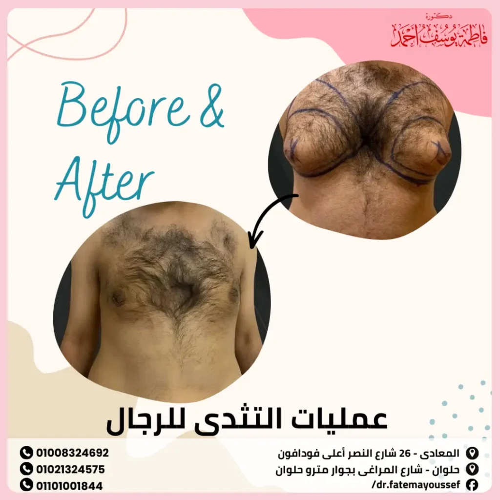 عمليات التثدي للرجال