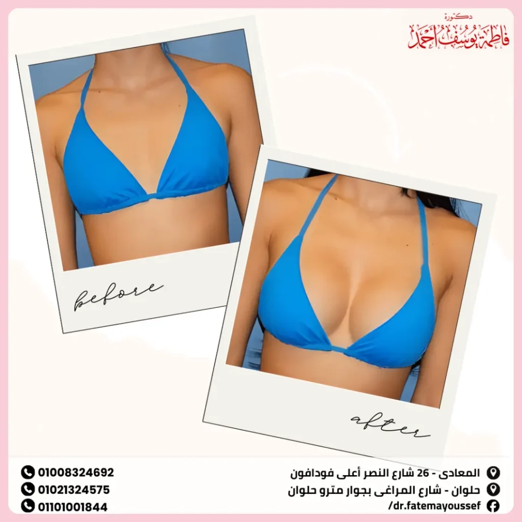 تجارب ناجحة لتكبير الثدي