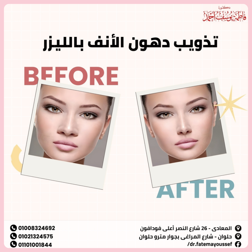 تذويب دهون الأنف بالليزر