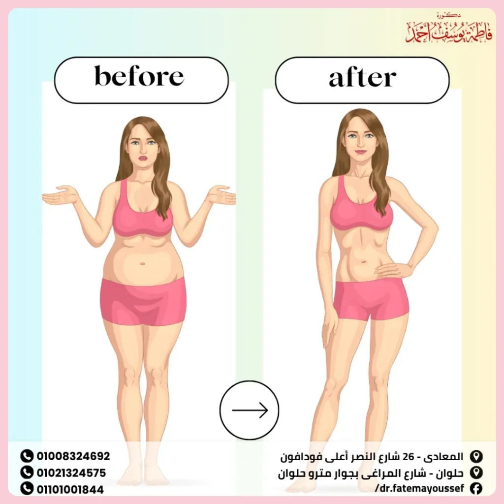 عملية ازالة الدهون من البطن