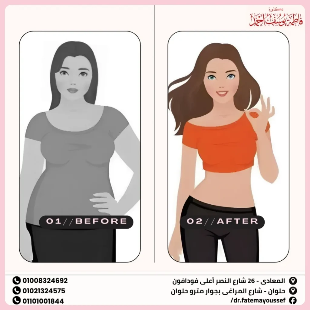 عملية ازالة الدهون من البطن
