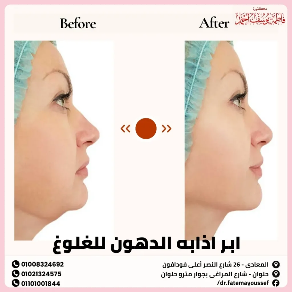 ابر اذابه الدهون للغلوغ