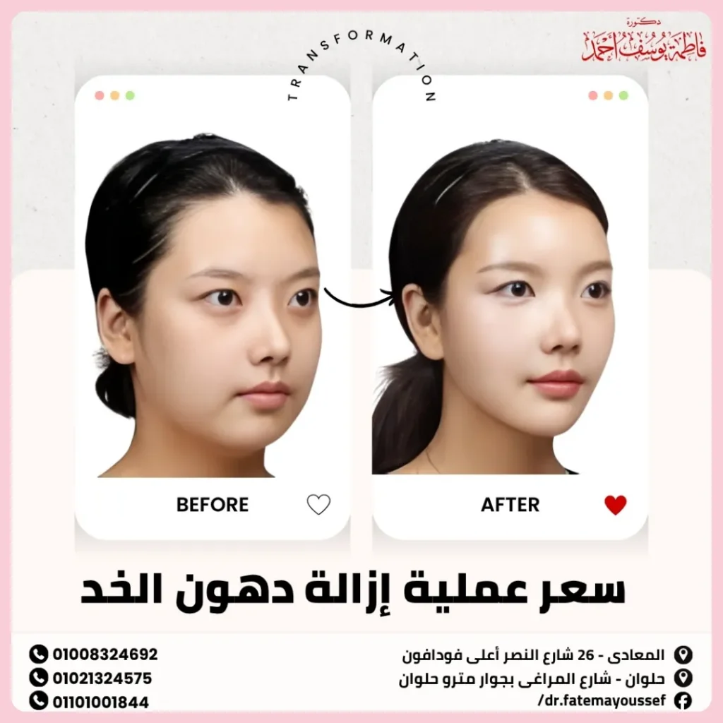 سعر عملية إزالة دهون الخد