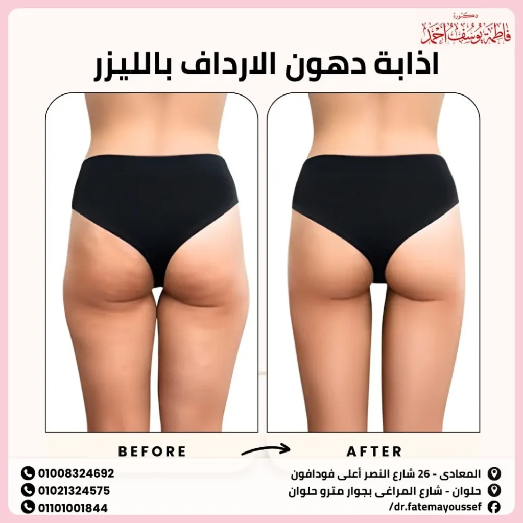 اذابة دهون الارداف بالليزر