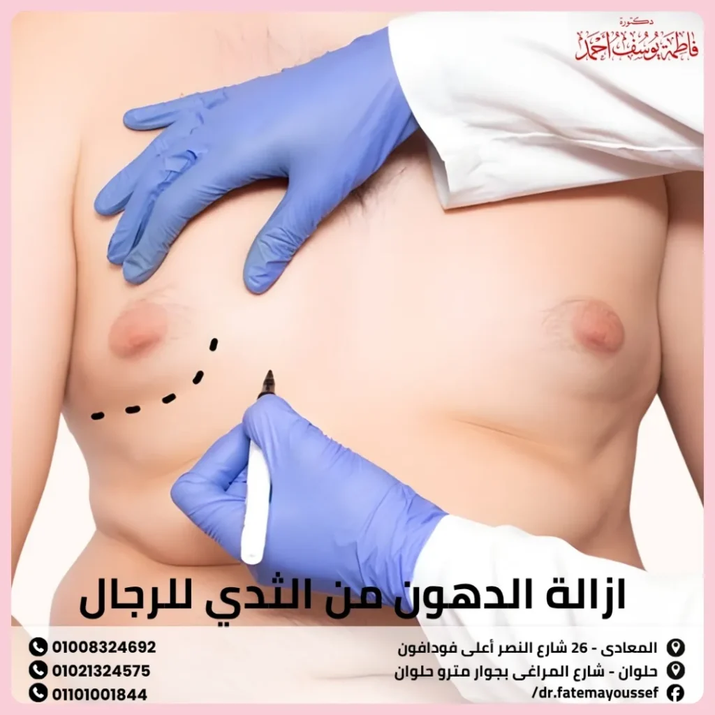 ازالة الدهون من الثدي للرجال