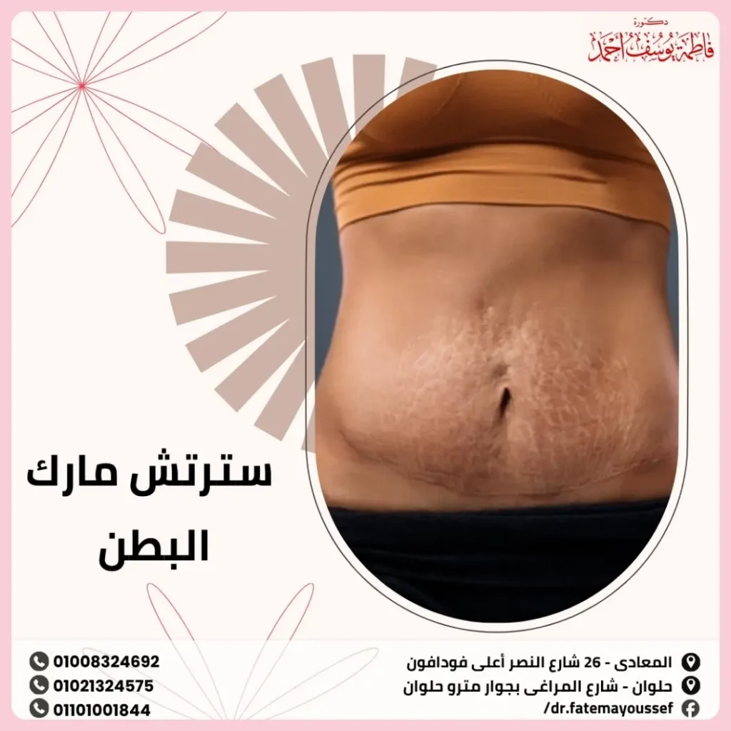 سترتش مارك البطن
