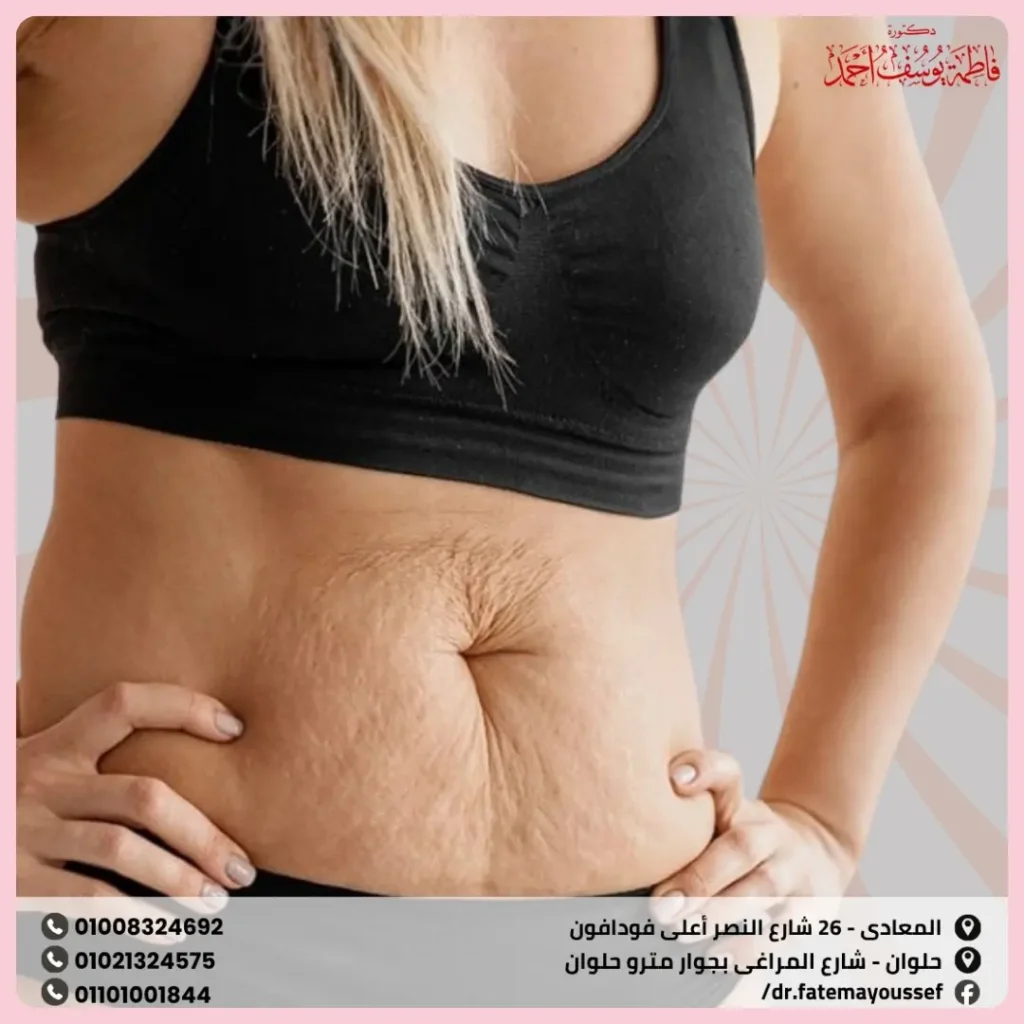 سترتش مارك البطن