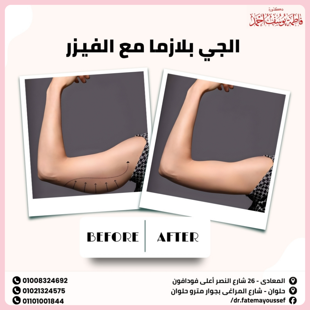 الجي بلازما مع الفيزر