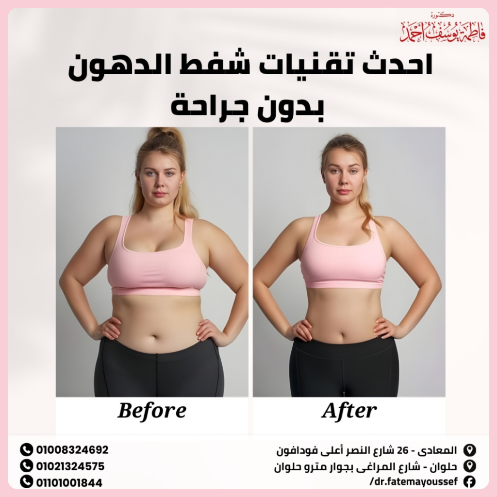 احدث تقنيات شفط الدهون بدون جراحة