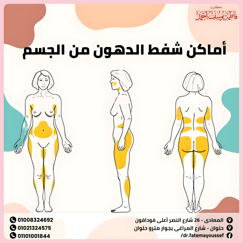 اماكن شفط الدهون من الجسم
