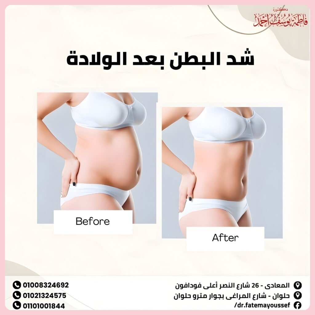 شد البطن بعد الولاده
