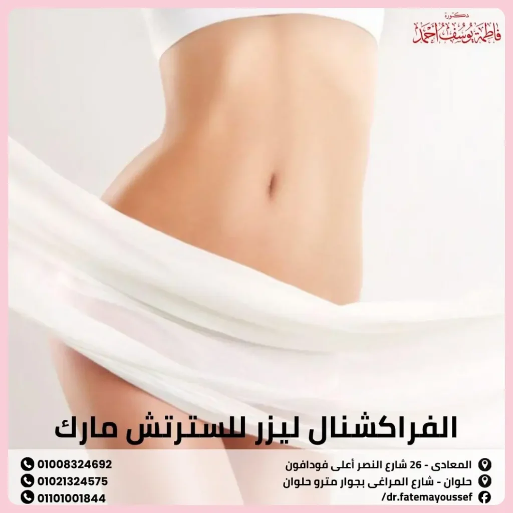 الفراكشنال ليزر للسترتش مارك