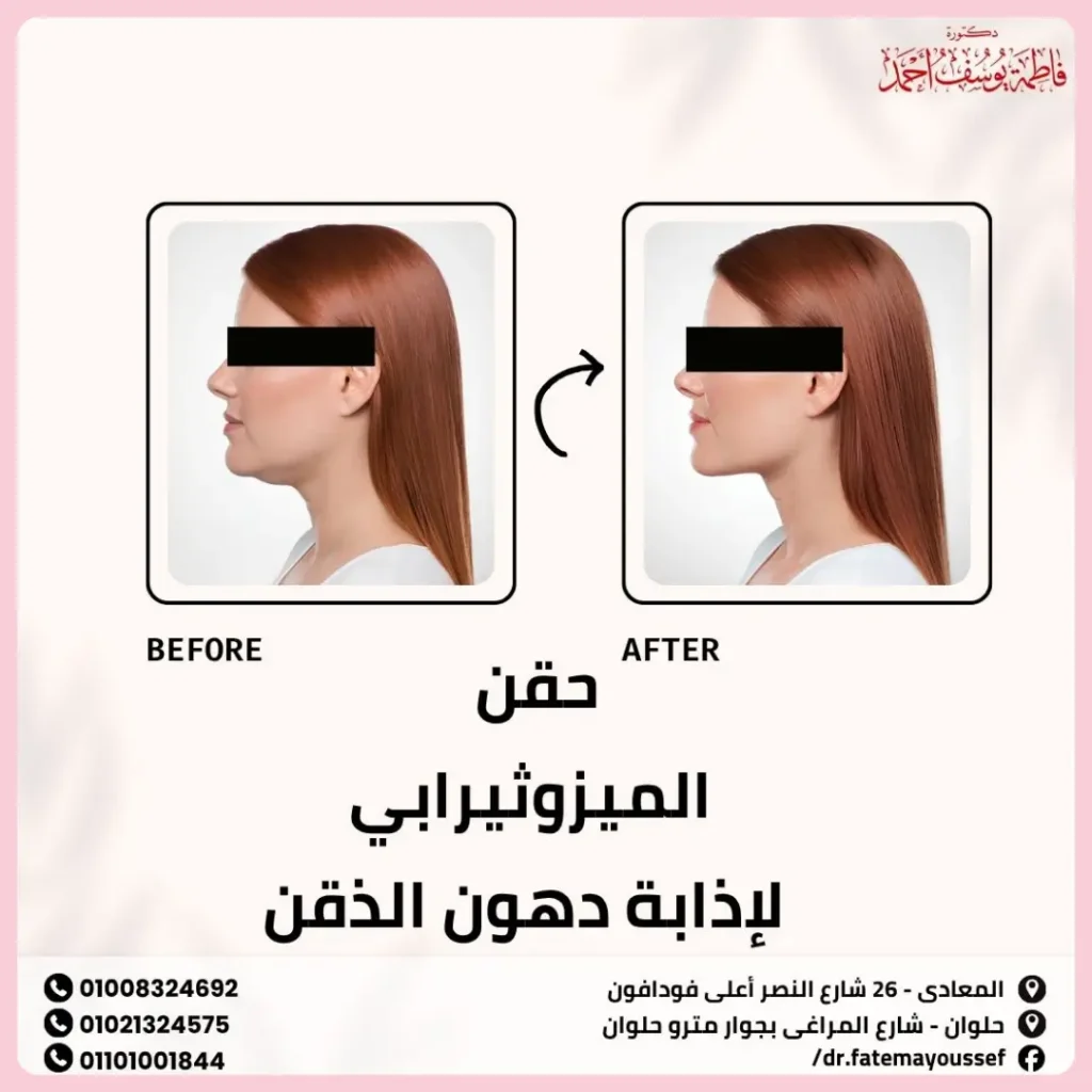 حقن الميزوثيرابي لإذابة دهون الذقن