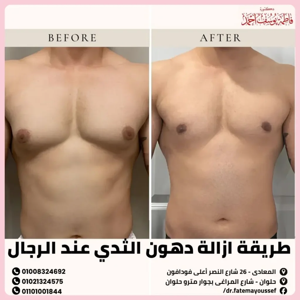 طريقة ازالة دهون الثدي عند الرجال