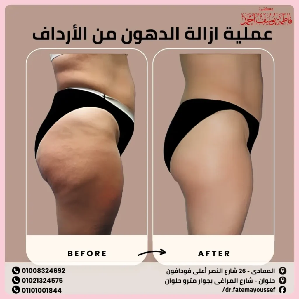 عملية ازالة الدهون من الارداف