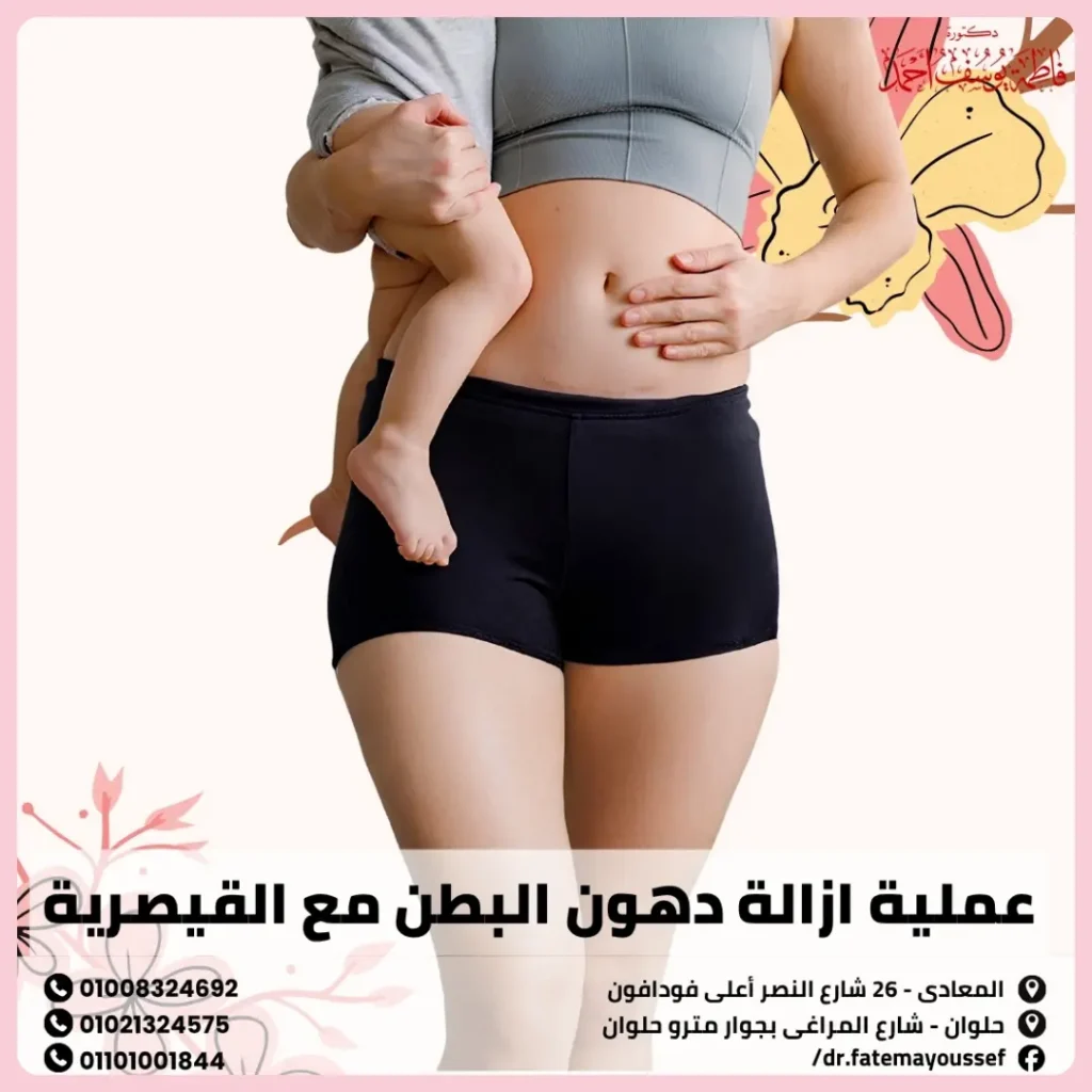 عملية ازالة دهون البطن مع القيصرية