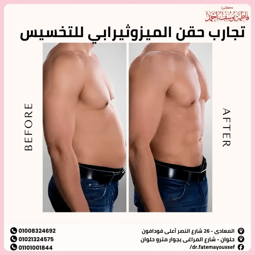 تجارب حقن الميزوثيرابي للتخسيس