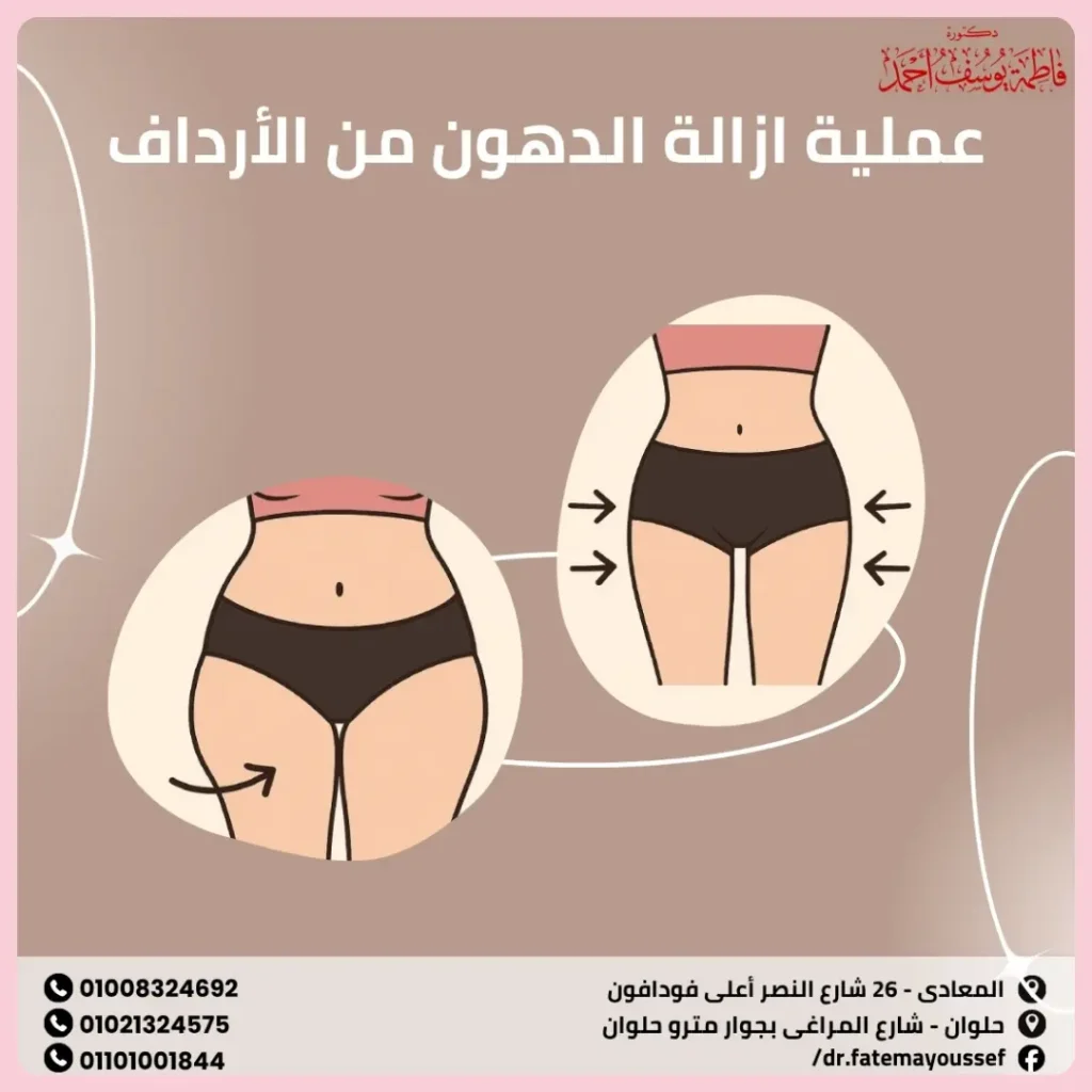 عملية ازالة الدهون من الارداف