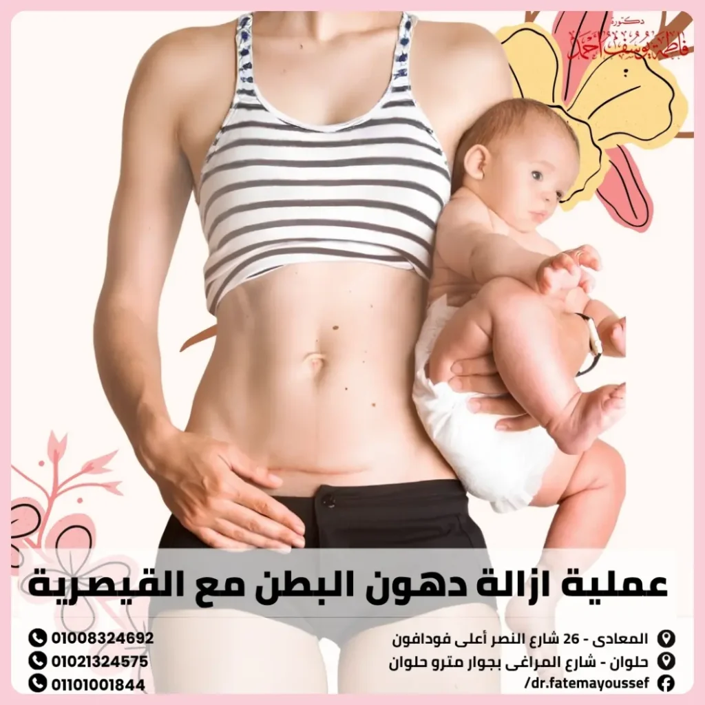 عملية ازالة دهون البطن مع القيصرية