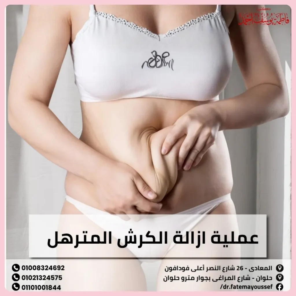 عملية ازالة الكرش المترهل: شد ونحت البطن