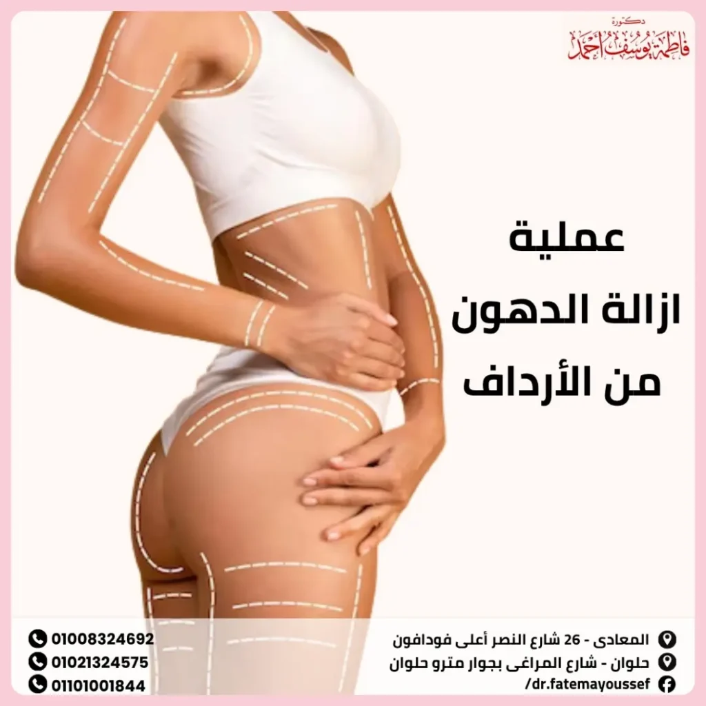 عملية ازالة الدهون من الارداف