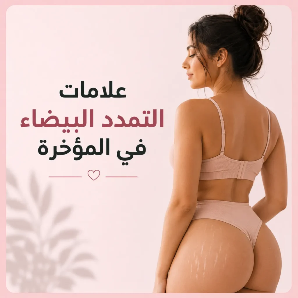 علامات التمدد البيضاء في المؤخرة
