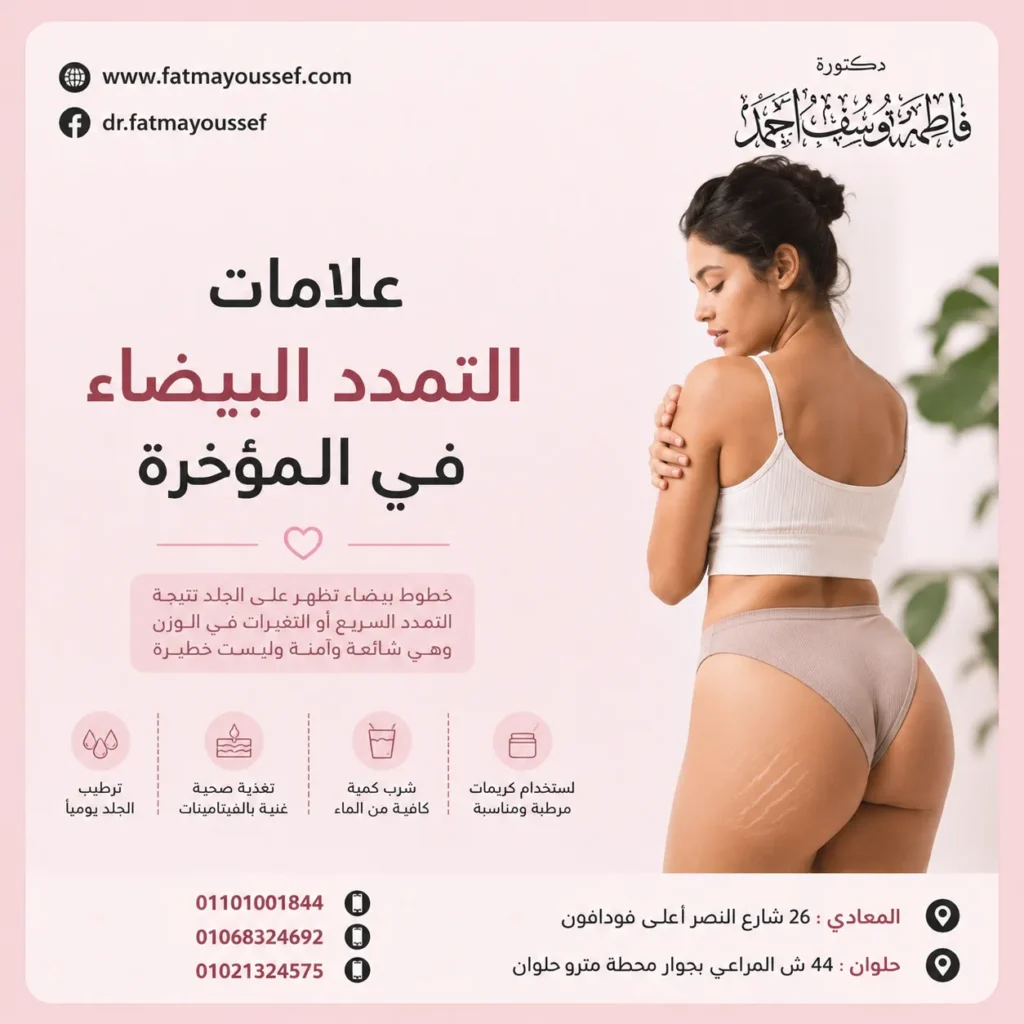 علامات التمدد البيضاء في المؤخرة