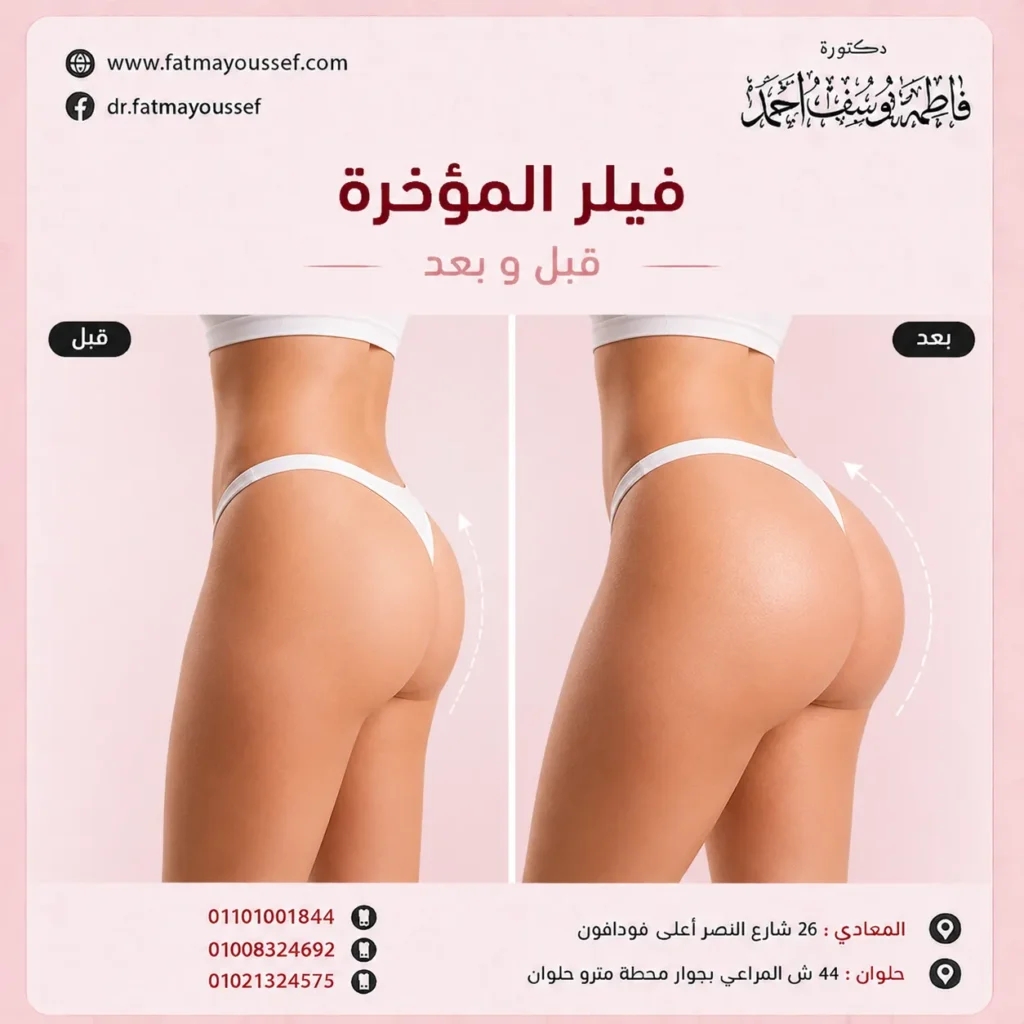فيلر المؤخرة قبل وبعد