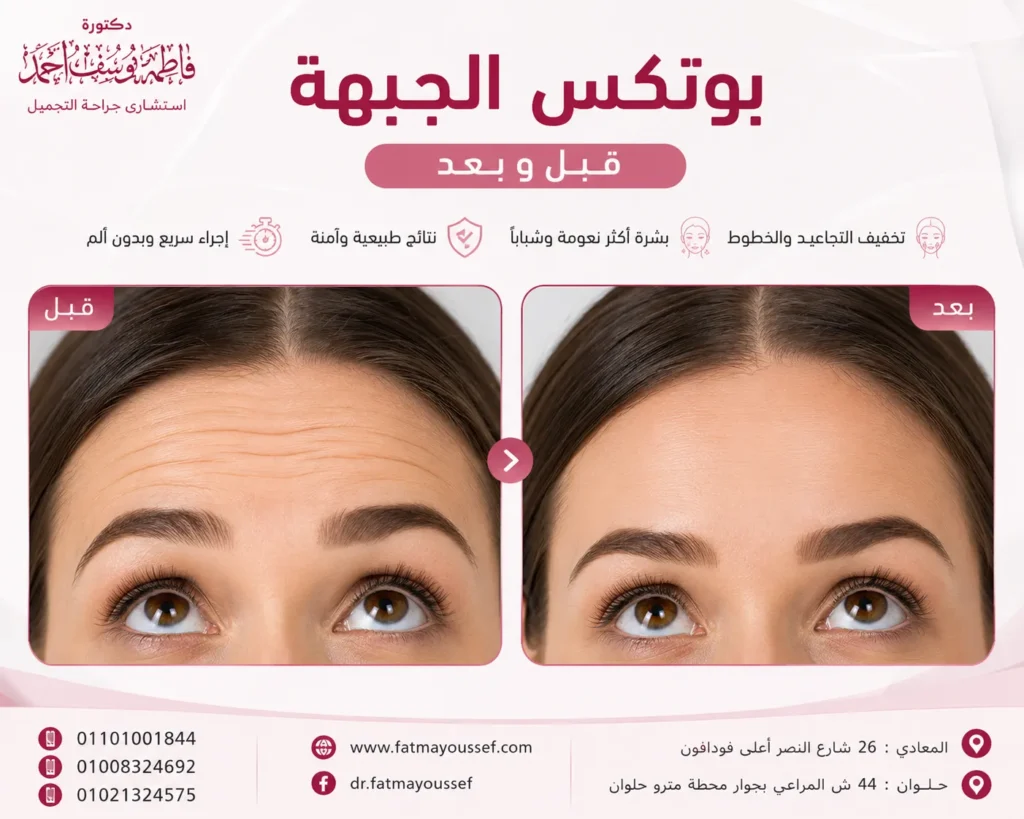 بوتكس الجبهة قبل وبعد