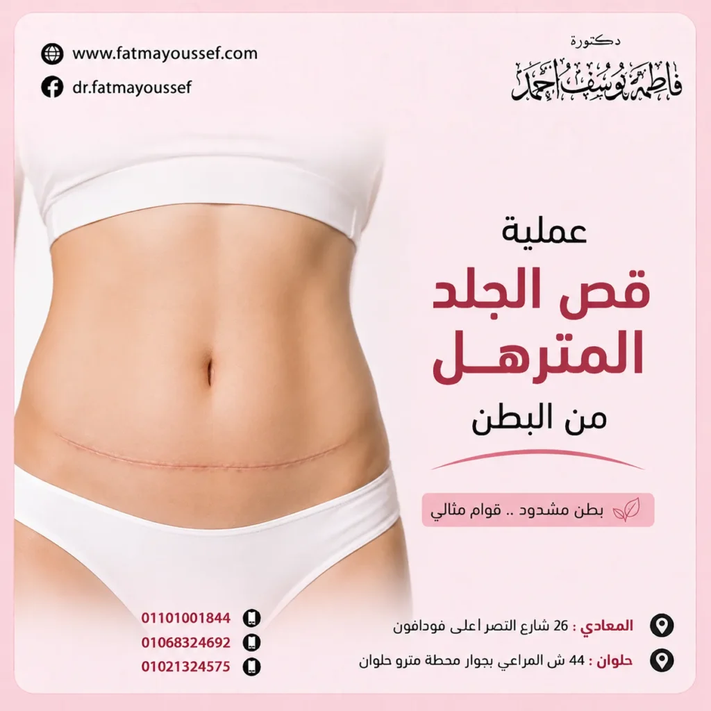 عملية قص الجلد المترهل من البطن