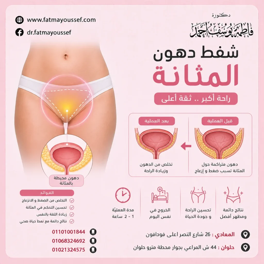 شفط دهون المثانة