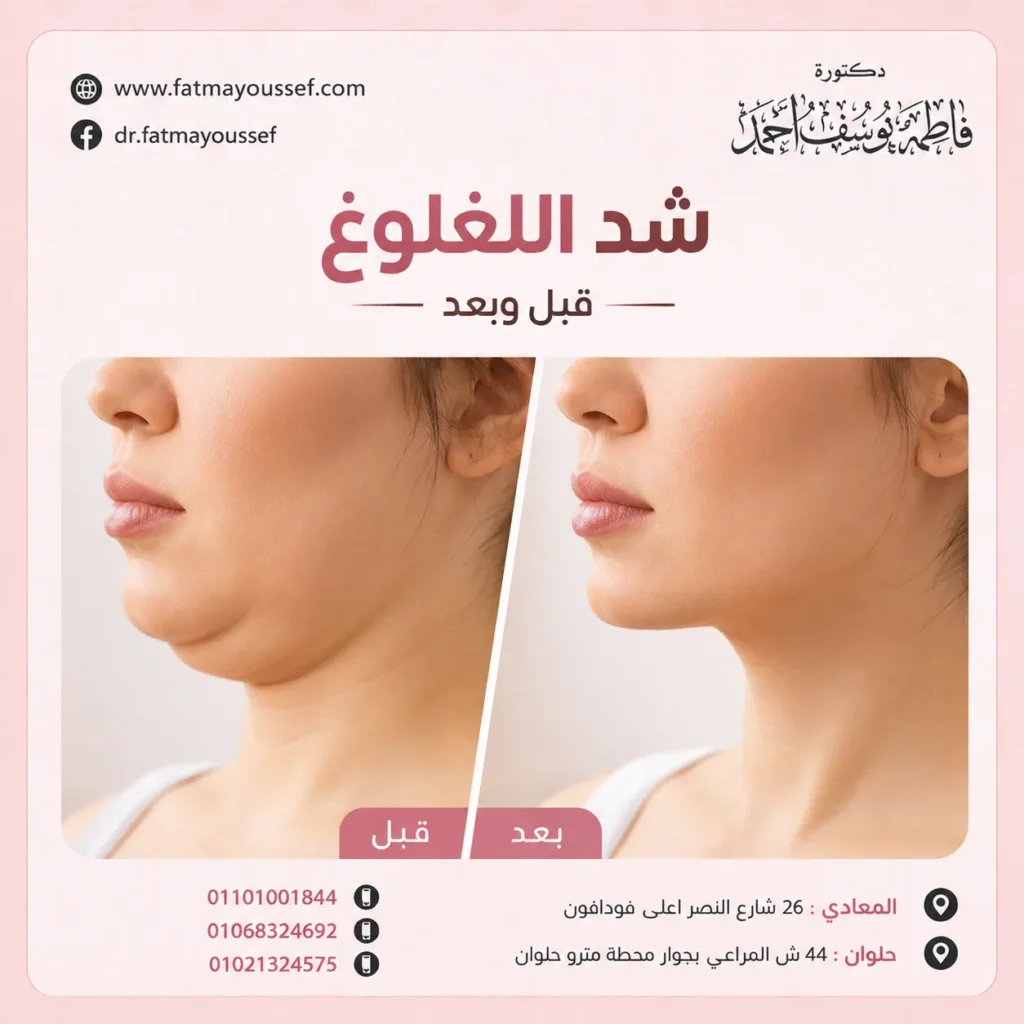 شد اللغلوغ قبل وبعد