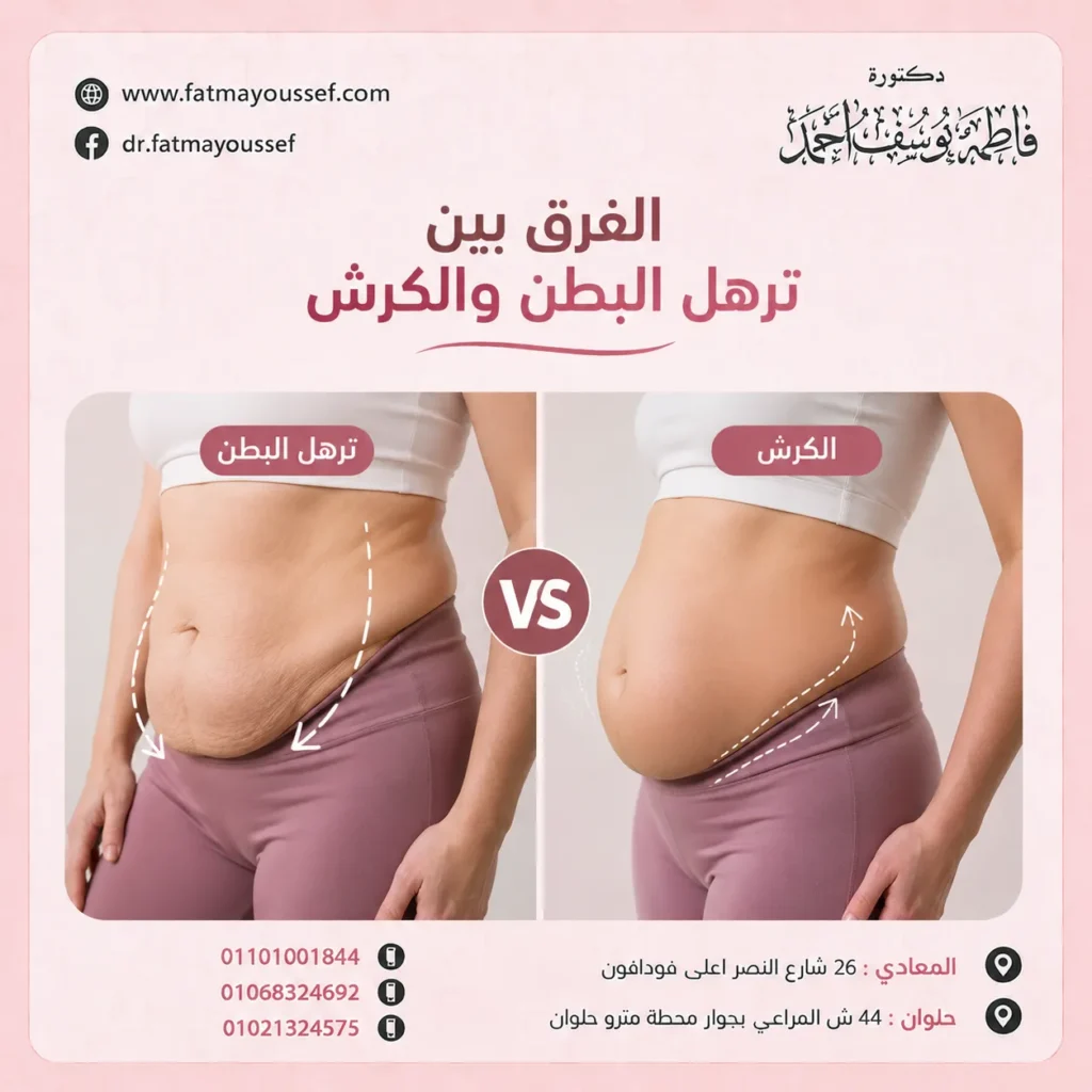 الفرق بين ترهل البطن والكرش