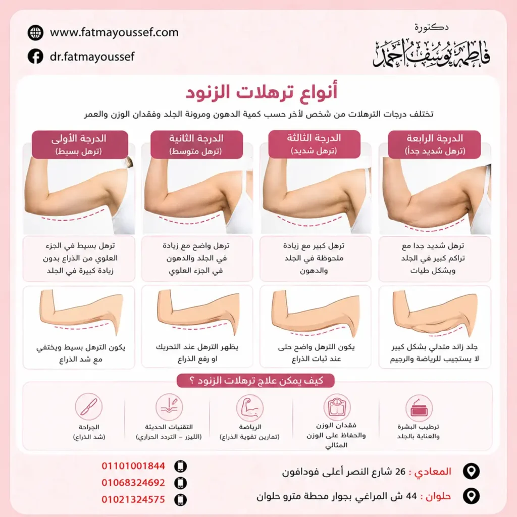 انواع ترهلات الزنود