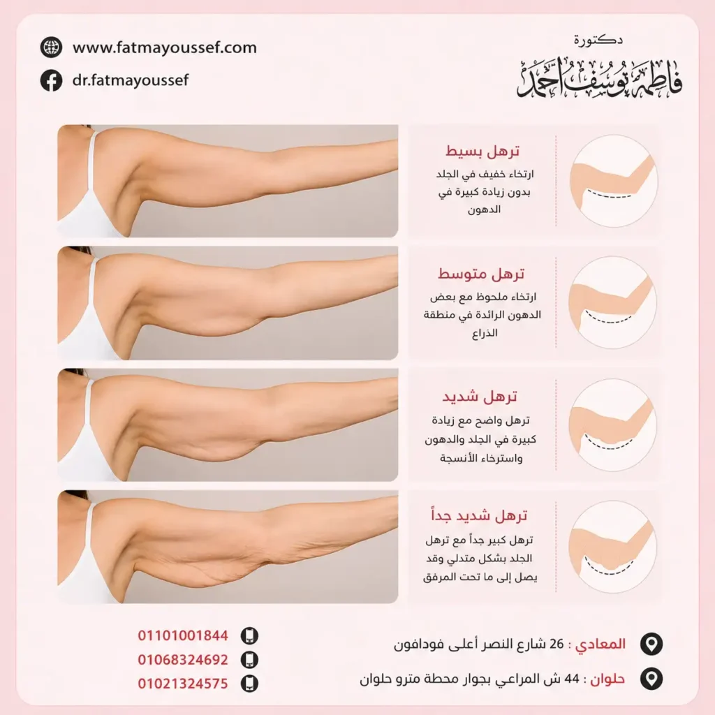 انواع ترهلات الزنود