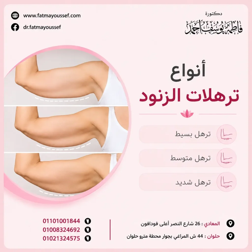 انواع ترهلات الزنود
