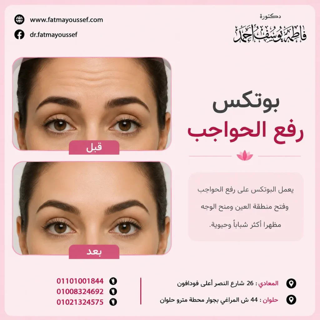 بوتكس رفع الحواجب قبل وبعد