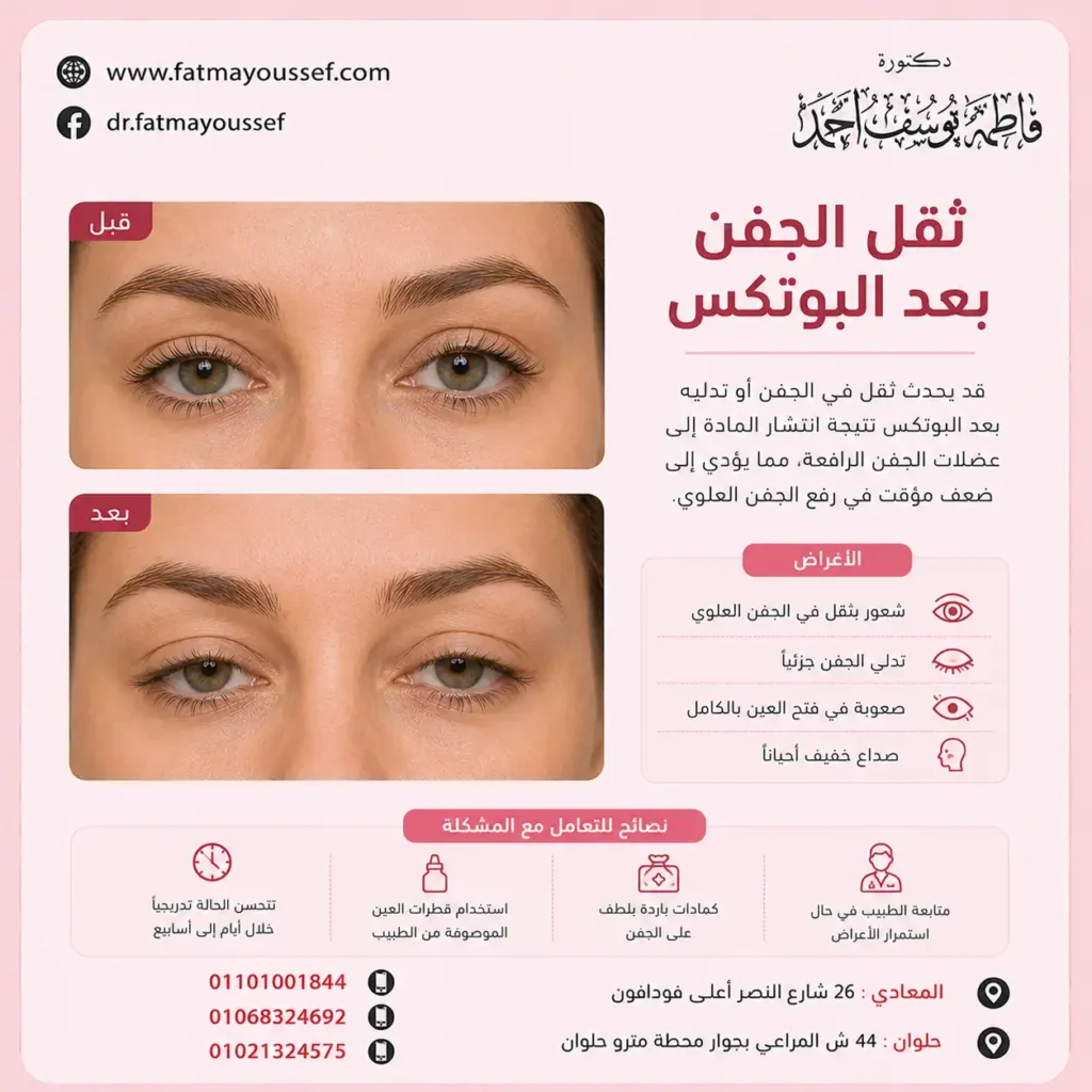 ثقل الجفن بعد البوتكس