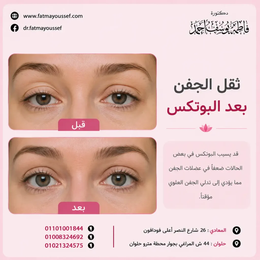 ثقل الجفن بعد البوتكس