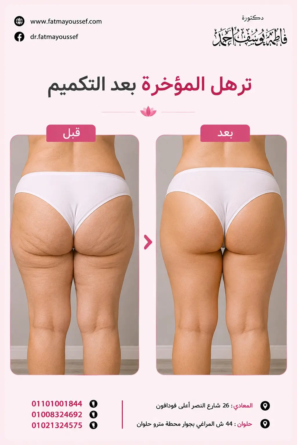 ترهل المؤخرة بعد التكميم