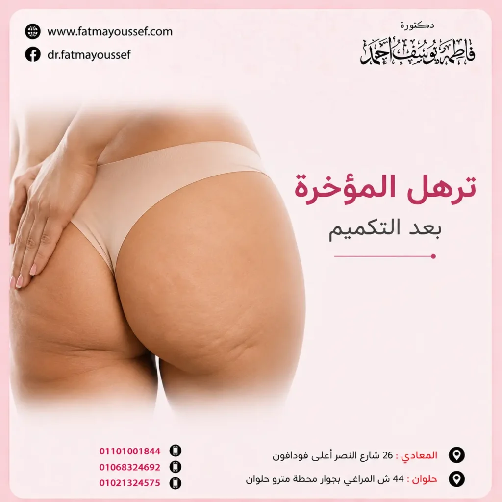 ترهل المؤخرة بعد التكميم