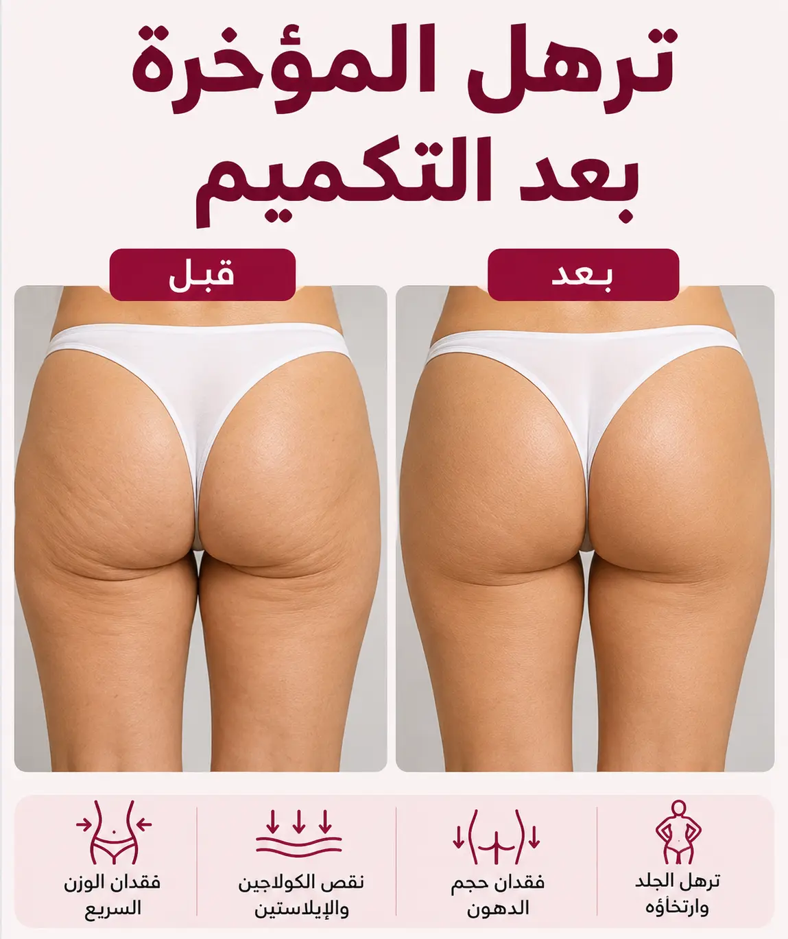 ترهل المؤخرة بعد التكميم