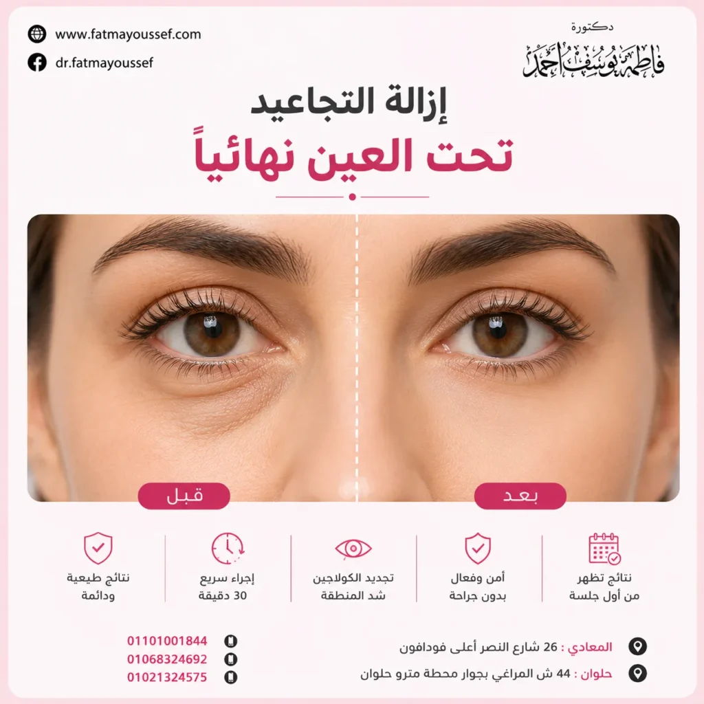 إزالة التجاعيد تحت العين نهائياً