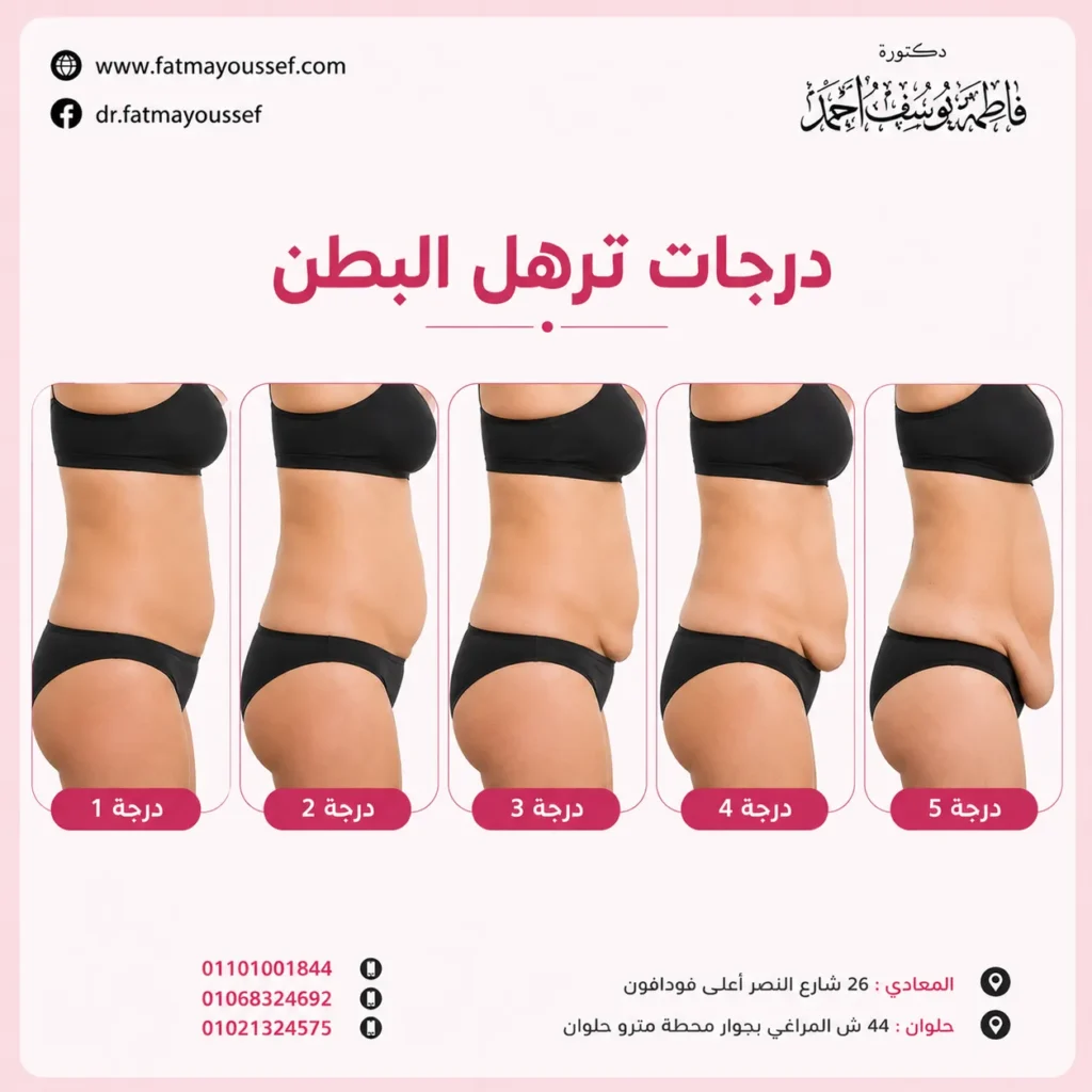 درجات ترهل البطن بالصور