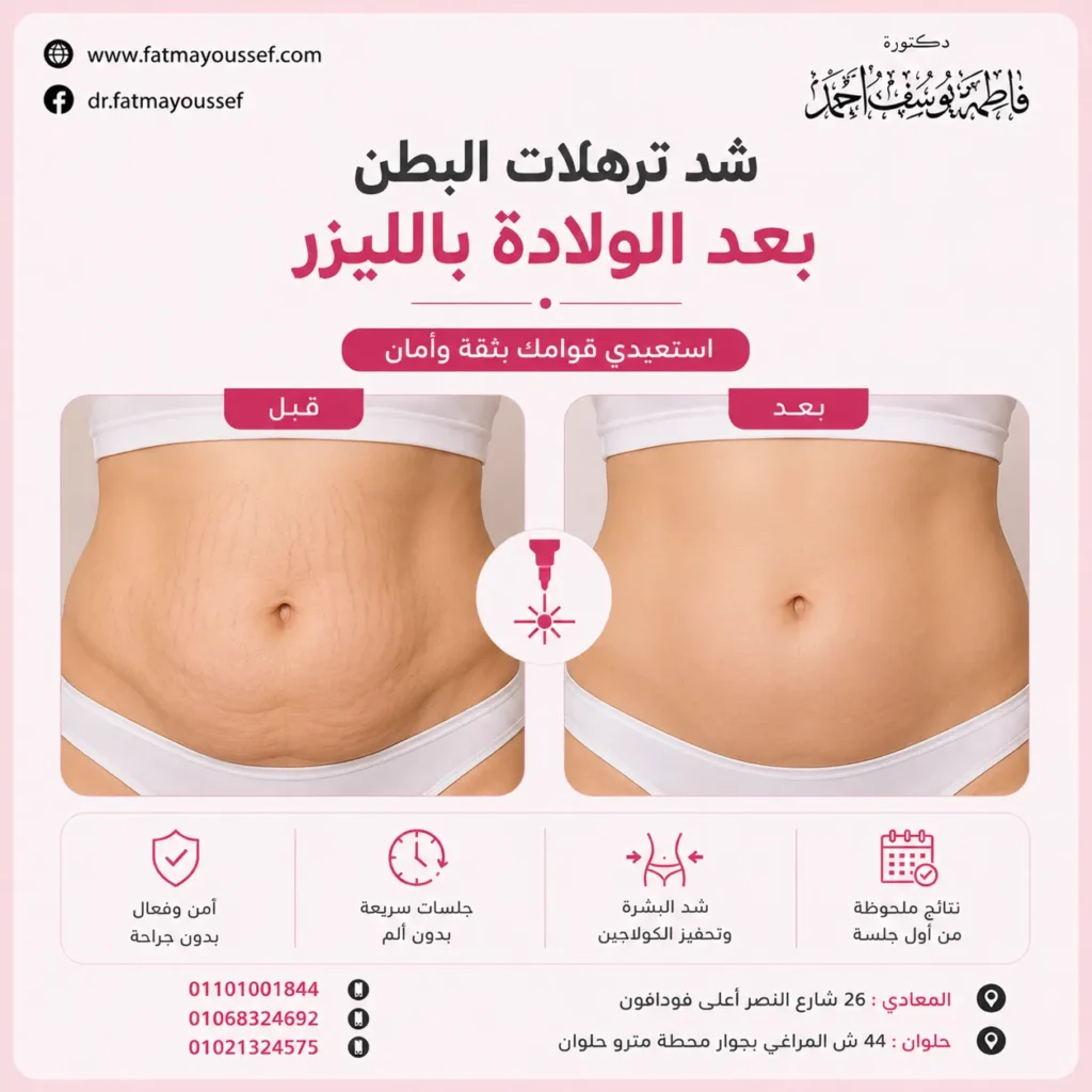 شد ترهلات البطن بعد الولادة بالليزر