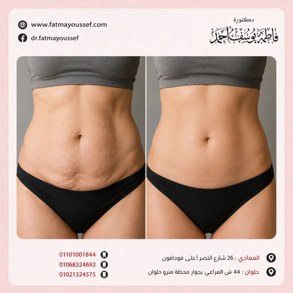 كيفية التخلص من ترهلات الجسم بعد الرجيم