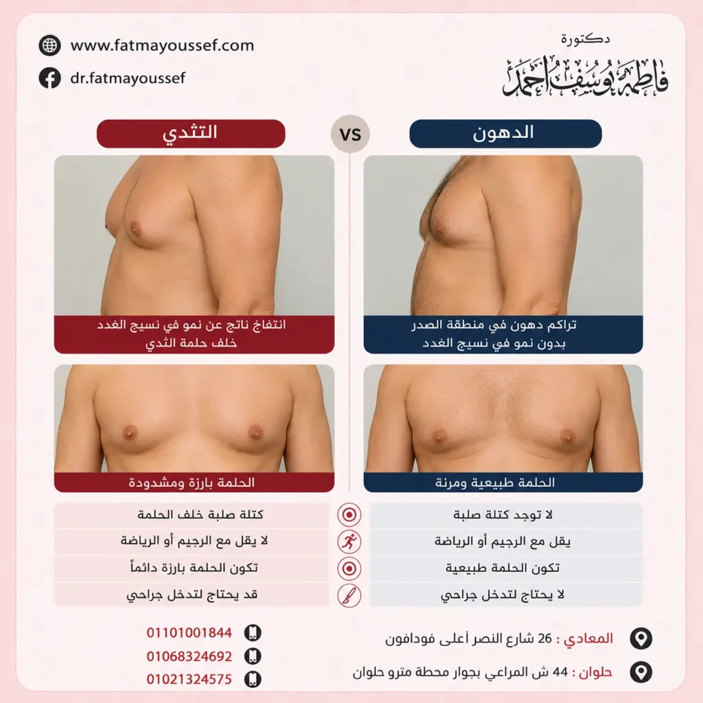 الفرق بين التثدي والدهون بالصور