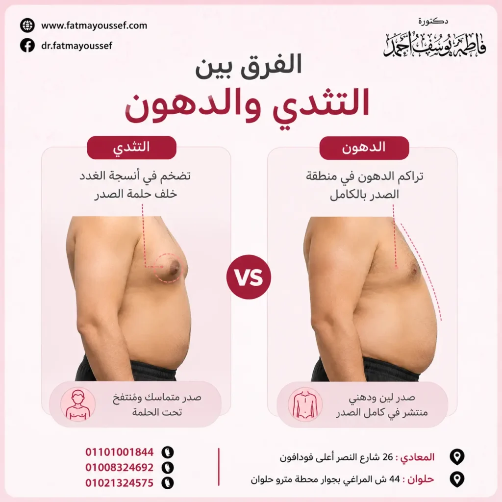 الفرق بين التثدي والدهون بالصور