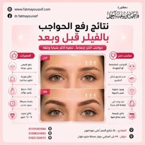 رفع الحواجب بالفيلر قبل وبعد