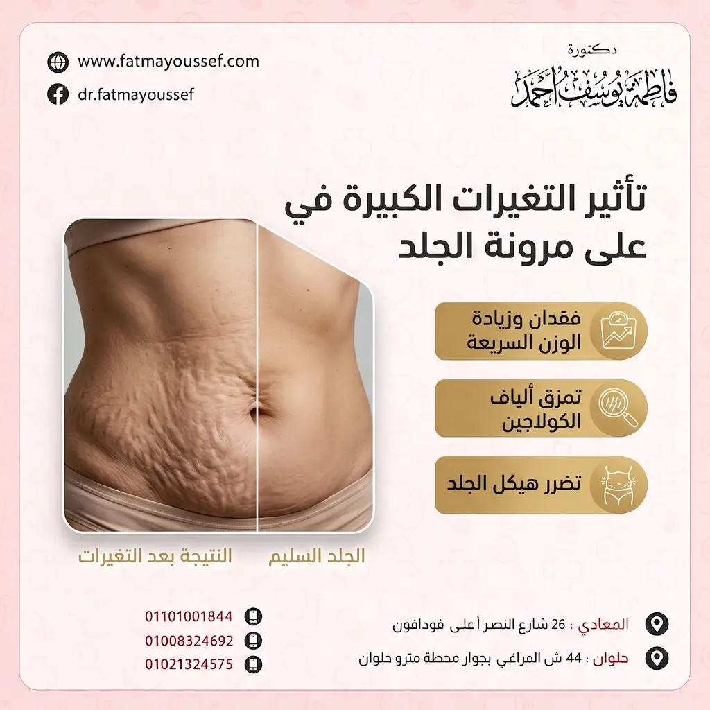 تأثير التغيرات الكبيرة في الوزن على مرونة الجلد